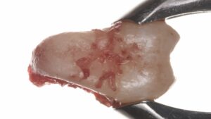 Karma Dentistry Blade