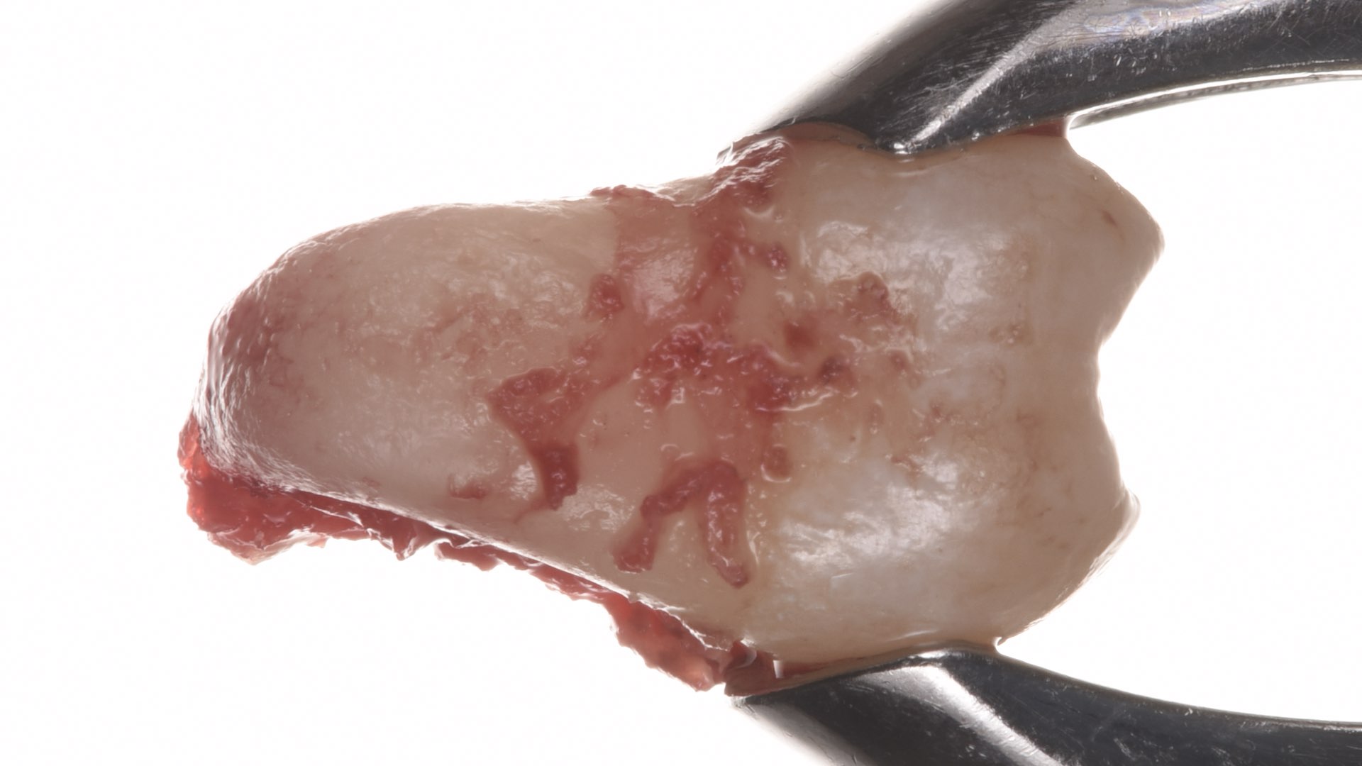 Karma Dentistry Blade