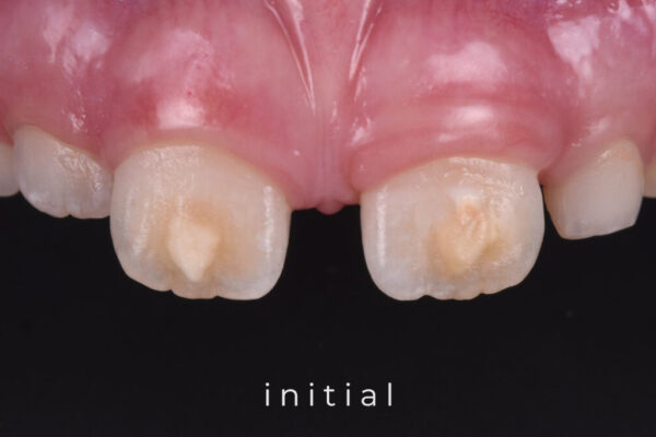 karma-dentistry-courses-infiltration-1