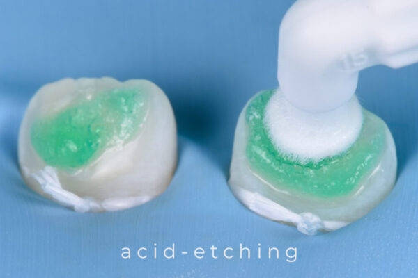 karma-dentistry-courses-infiltration-4