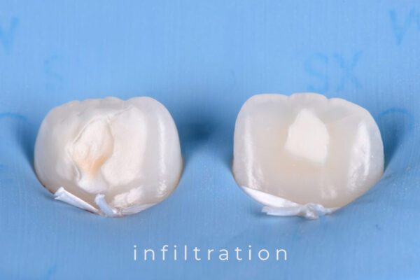 karma-dentistry-courses-infiltration-5