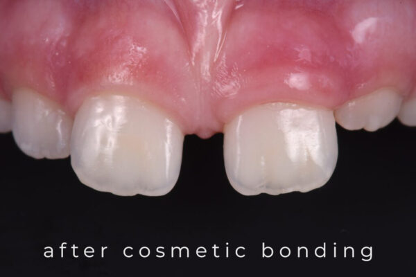 karma-dentistry-courses-infiltration-6